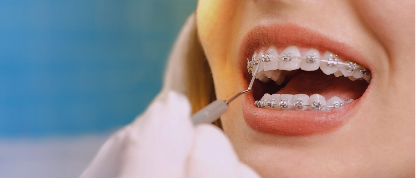 como-lavarse-dientes-brackets